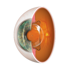 ICL（眼内コンタクトレンズ）とは