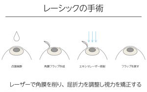 レーシックの手術方法