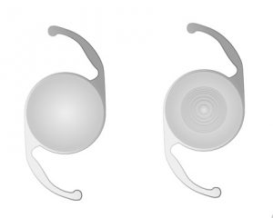 単焦点眼内レンズと多焦点眼内レンズ