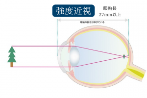 強度近視